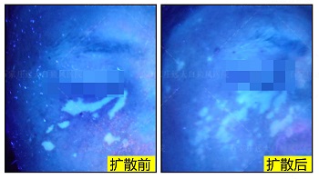 白斑多久不会变大就没事 白癜风白斑长什么样