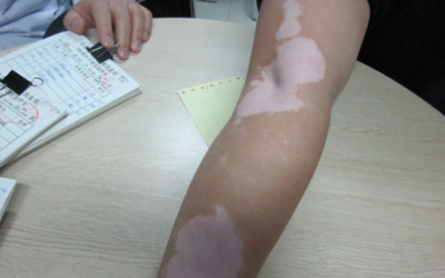 胳膊上有小白点 白点是什么