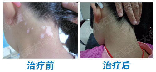 白癜风黑色素移植恢复的过程