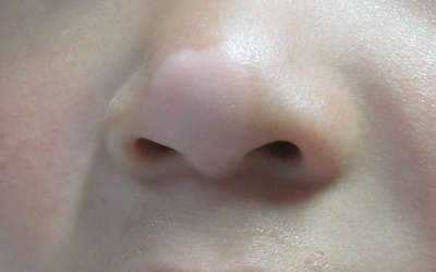 宝宝鼻梁中间的皮肤比其他白咋回事