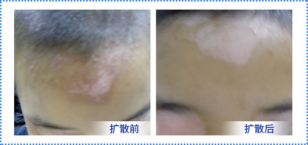 眉尾白癜风一个月了有发展的迹象是什么病