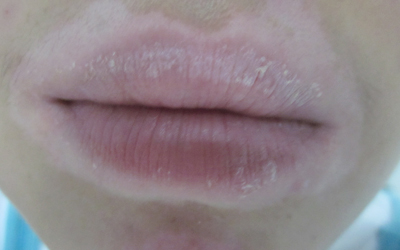 嘴唇粘膜白斑图片