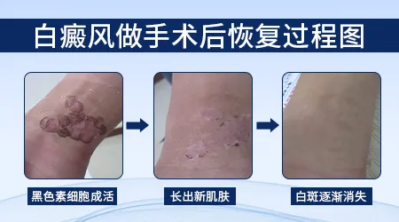 伍德灯下白斑边界清晰是好事还是坏事