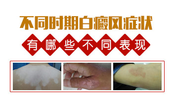 阴囊白斑是什么病 受过伤会得白癜风吗
