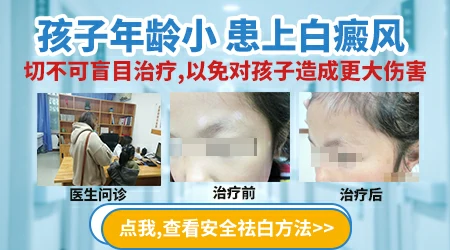 小孩白癜风早期有什么好的治疗方法