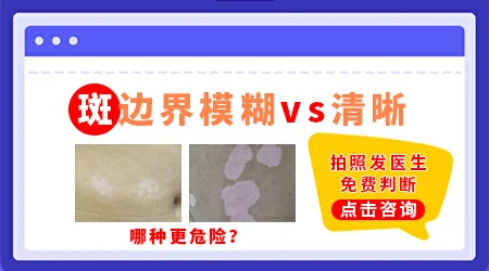白癜风的白斑边界变模糊是要扩散吗