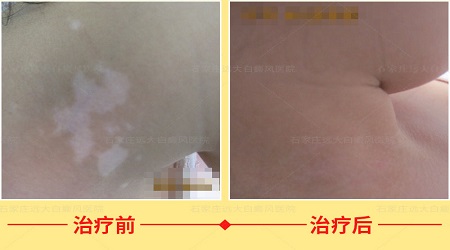 婴幼儿白癜风有什么方法治疗比较安全