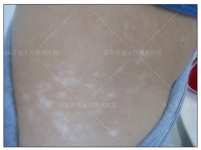 指甲盖大小的白斑是什么 治好花费多少钱