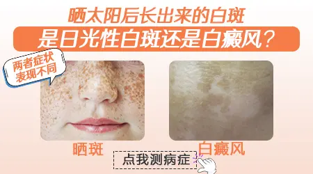 暴晒后肩膀上出现白色的点点怎么办