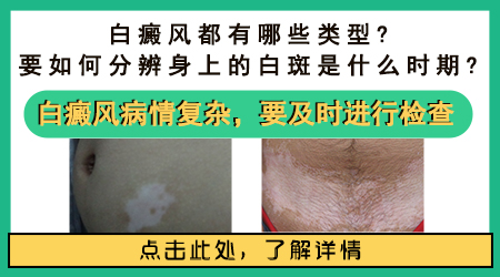 白斑快一个月了没变大是不是白癜风