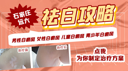 石家庄儿童白癜风医院