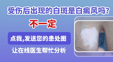 怎样区分受伤白和白癜风