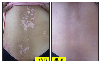 紫外线照射白癜风3个月是一疗程吗