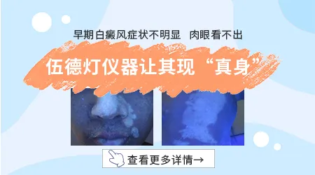 宝宝长白癜风ZUI初期的样子图片
