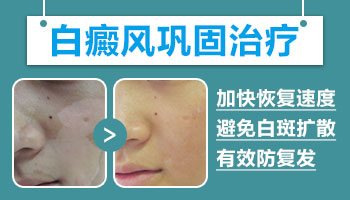 白癜风抗复发是几月份需要做比较好