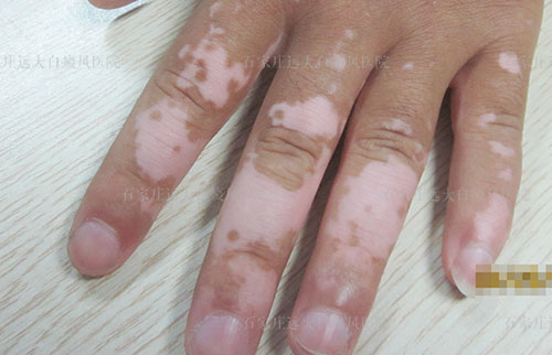 十个手指前端都是白点一年多了是什么病