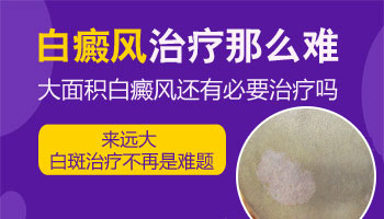 白癜风大面积可以治愈吗