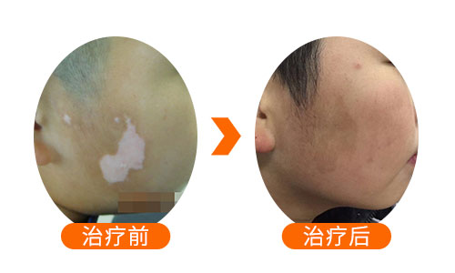 伍德灯检查白斑写着+什么意思