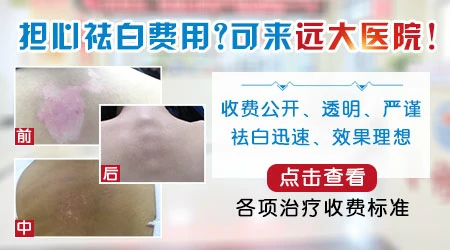 白癜风的治疗费用一般是多少