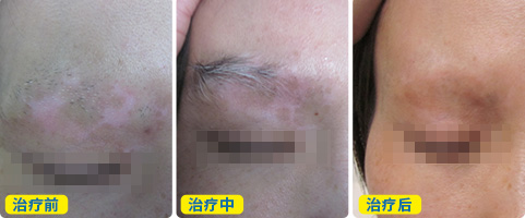 河北治白癜风ZUI好的医院