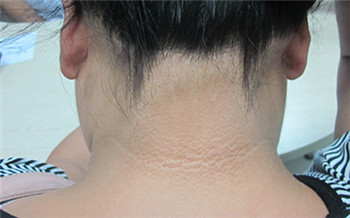 脖子处皮肤有一部分很白很光滑