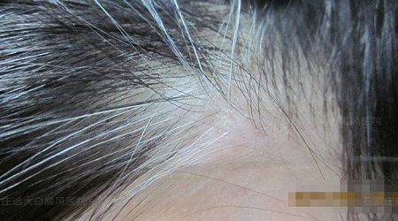 头皮突然变白并有白头发是什么原因