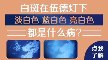 伍德灯下初期白斑图片