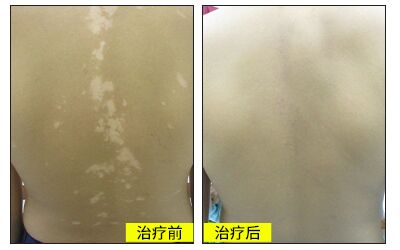 白癜风做了激光会不会影响怀孕