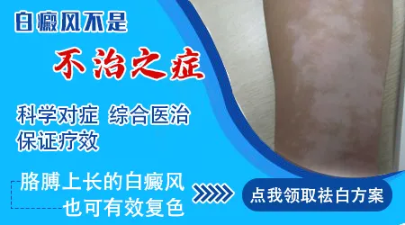 白癜风发展到什么程度就治不好了