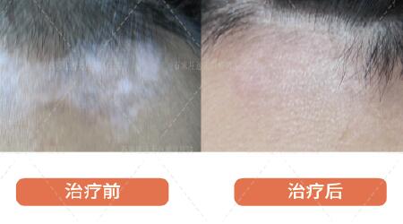 白癜风移植成功率 白癜风移植对比图