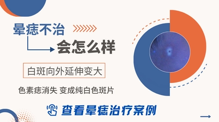 黑痣周围皮肤变白了怎么回事