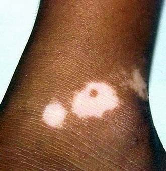 散发型白癜风怎么诊断?