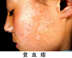 怎样区分白癜风与贫血痣