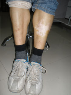 中医细胞免疫疗法治疗神经节段型白癜风一例