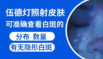 伍德灯下淡白色白点是白癜风吗