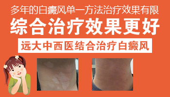 治白斑什么药效果ZUI好
