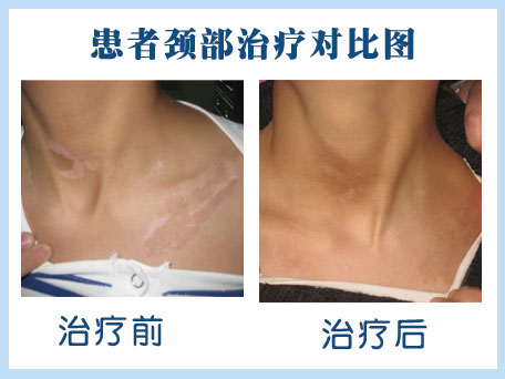 进展期白癜风治疗-“白癜风蜕变康复工程”
