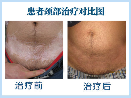 腹部白癜风-“白癜风蜕变康复工程”