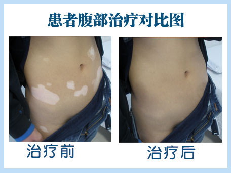 白斑 有情人终成眷属