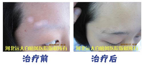 少女终于脱离了白癜风的阴影