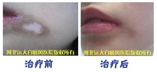 白癜风女孩的悲与乐