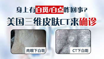 面部白癜风发红发痒