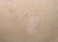 黑豆怎么吃能帮助白癜风恢复