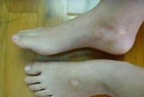 人身上长的白斑