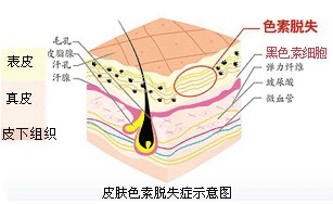 308准分子治疗白癜风