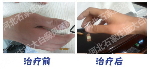 手上得了白癜风该怎么治疗