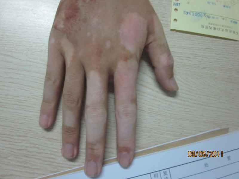 节段型白癜风症状表现全解析