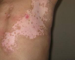 皮肤过敏会发生白癜风吗