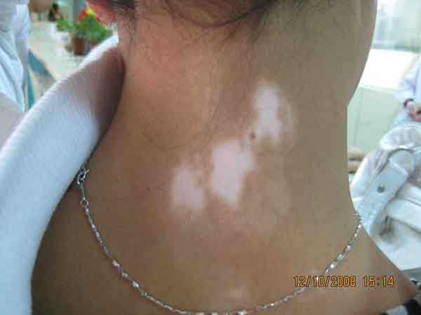 脖子上的白斑是不是白癜风?怎么确诊?