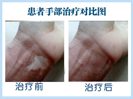 帮助学生摆脱白斑 减轻心理压力